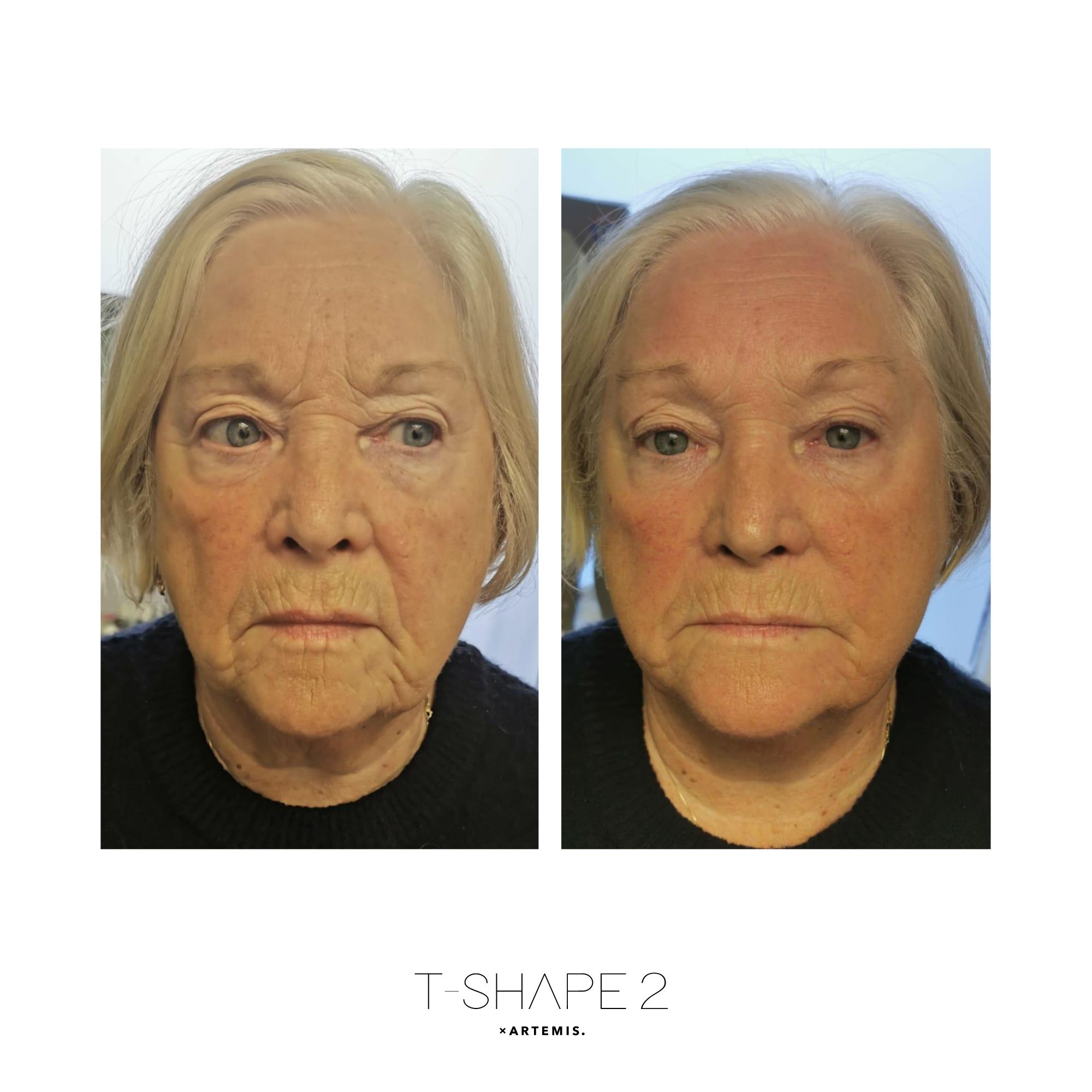 T-Shape 2 before and after — After 1 Treatment