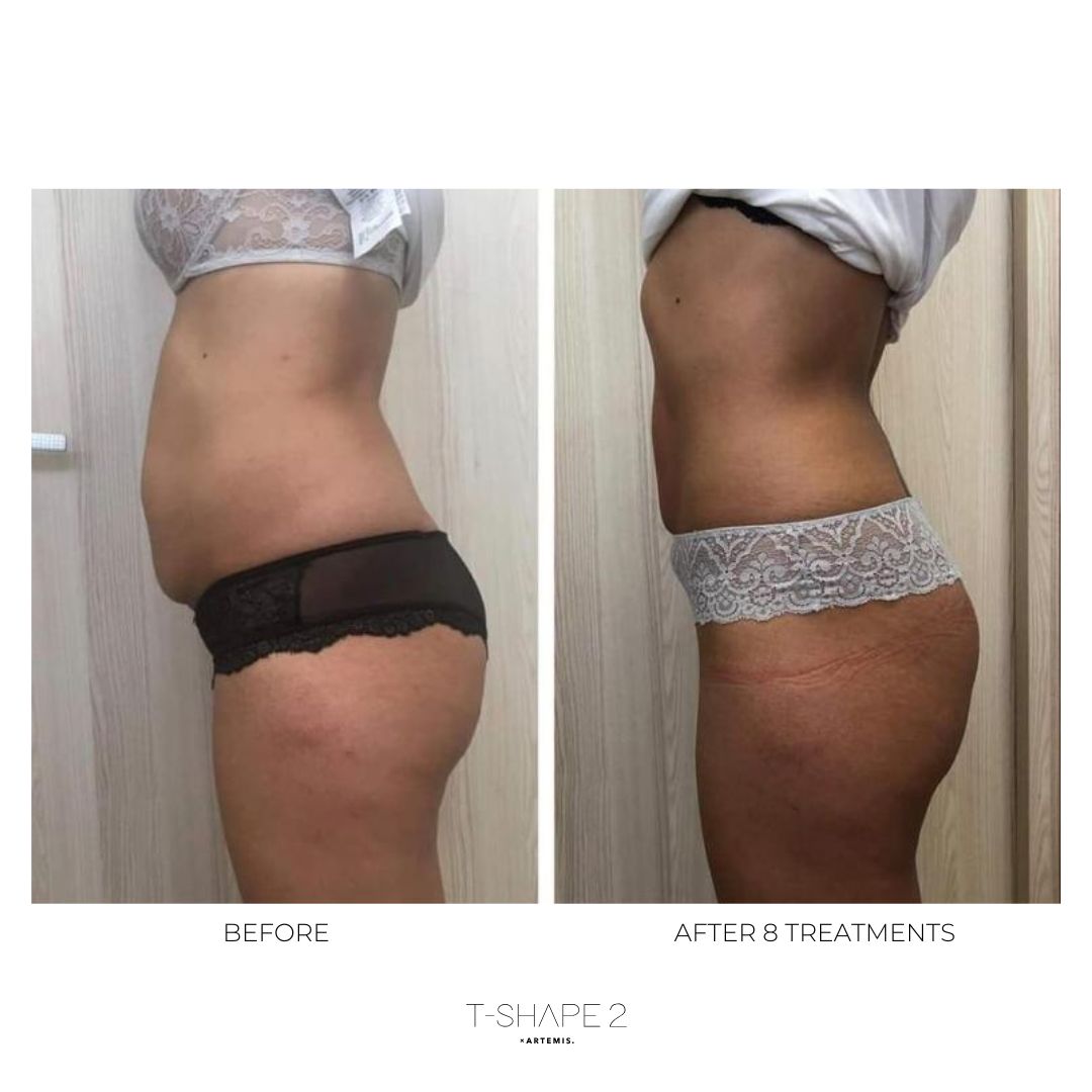 T-Shape 2 before and after — After 8 Treatments
